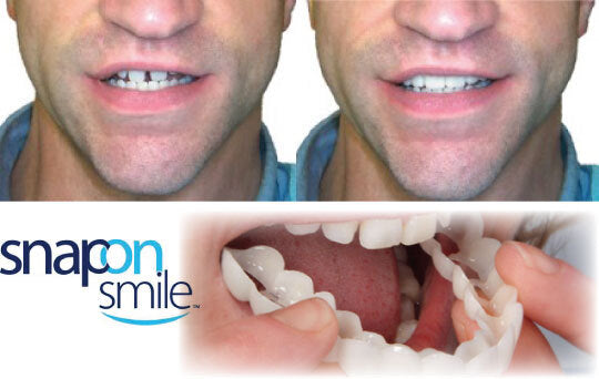 Carillas Dentales Snap On Smile - Sonrisa Perfecta al Instante