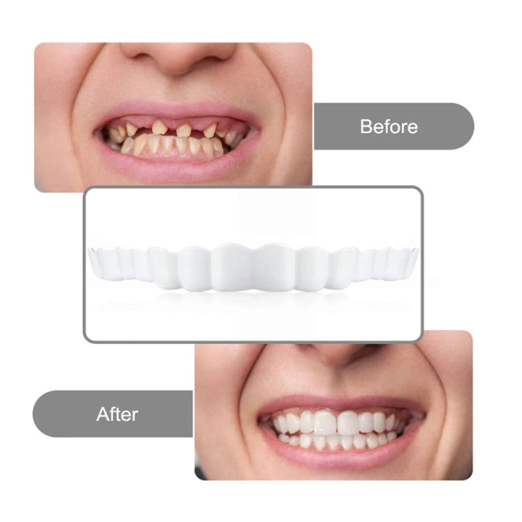 Carillas Dentales Snap On Smile - Sonrisa Perfecta al Instante