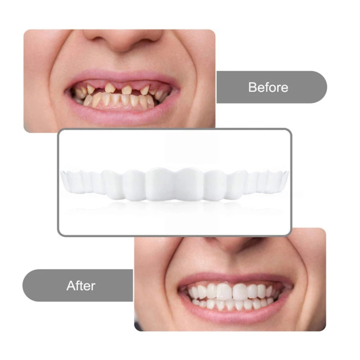 Carillas Dentales Snap On Smile - Sonrisa Perfecta al Instante